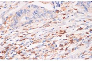 Immunohistochemistry of paraffin-embedded Human colon carcinoma using CYBA Polyclonal Antibody at dilution of 1:100 (40x lens). (CYBA Antikörper)
