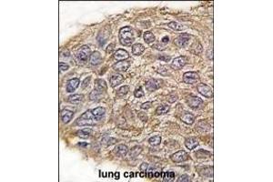 Formalin-fixed and paraffin-embedded human lung carcinoma tissue reacted with ALDOA antibody (N-term) (ABIN389191 and ABIN2839354) , which was peroxidase-conjugated to the secondary antibody, followed by DAB staining. (ALDOA Antikörper  (N-Term))
