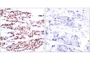 Immunohistochemistry analysis of paraffin-embedded human breast carcinoma, using JunB (Phospho-Ser79) Antibody. (JunB Antikörper  (pSer79))