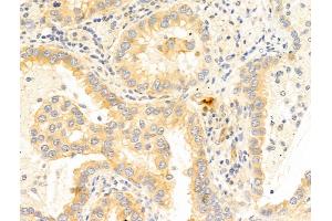 ABIN6266055 and ABIN6273350 at 1/100 staining Human lung cancer by IHC-P.