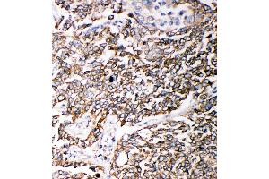 Anti-PMP70 antibody, IHC(P) IHC(P): Human Lung Cancer Tissue (CX3CL1 Antikörper  (C-Term))