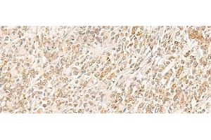 Immunohistochemistry of paraffin-embedded Human gastric cancer tissue using MYCT1 Polyclonal Antibody at dilution of 1:35(x200) (Myc Target 1 Antikörper)