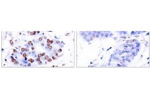Immunohistochemical analysis of paraffin-embedded human breast carcinoma tissue using NF-κB p65 (Ab-276) antibody (E021011). (NF-kB p65 Antikörper)