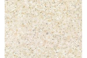 ABIN6265567 and ABIN6277714 at 1/100 staining human astrocytoma by IHC-P.
