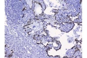 IHC analysis of Cytokeratin 19 using anti-Cytokeratin 19 antibody (ABIN3043288).