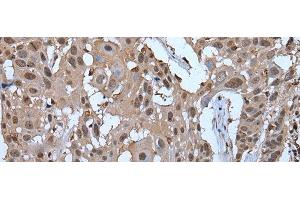 Immunohistochemistry of paraffin-embedded Human esophagus cancer tissue using ZNF787 Polyclonal Antibody at dilution of 1:45(x200) (ZNF787 Antikörper)