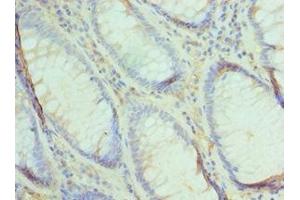 Immunohistochemistry of paraffin-embedded human colon cancer using ABIN7174493 at dilution of 1:100 (UBE2V2 Antikörper  (AA 1-145))