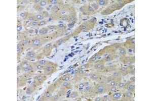 Immunohistochemistry of paraffin-embedded Human liver damage using UGT2B10 Polyclonal Antibody at dilution of 1:100 (40x lens). (UGT2B10 Antikörper)