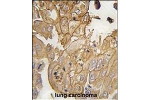 Formalin-fixed and paraffin-embedded human lung carcinoma tissue reacted with GMFG antibody (N-term) (ABIN392351 and ABIN2841990) , which was peroxidase-conjugated to the secondary antibody, followed by DAB staining.