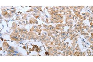 Immunohistochemistry of paraffin-embedded Human lung cancer tissue using FGF1 Polyclonal Antibody at dilution 1:50 (FGF1 Antikörper)