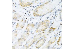 Immunohistochemistry of paraffin-embedded human gastric cancer using SULT2 Antibody (4063) at dilution of 1:200 (40x lens). (SULT2A1 Antikörper  (AA 1-145))