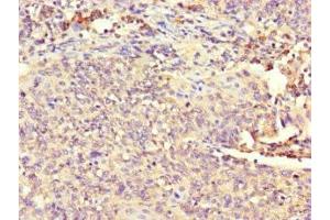Immunohistochemistry of paraffin-embedded human cervical cancer using ABIN7163366 at dilution of 1:100 (ATP8A1 Antikörper  (AA 448-545))