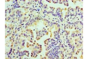 Immunohistochemistry of paraffin-embedded human lung cancer using ABIN7167634 at dilution of 1:100 (RMDN3 Antikörper  (AA 1-470))