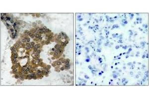 Immunohistochemistry analysis of paraffin-embedded human lung carcinoma, using Akt2 (Phospho-Ser474) Antibody. (AKT2 Antikörper  (pSer474))