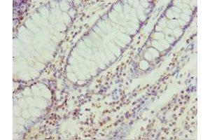 Immunohistochemistry of paraffin-embedded human colon cancer using ABIN7151256 at dilution of 1:100 (TRIM32 Antikörper  (AA 1-280))