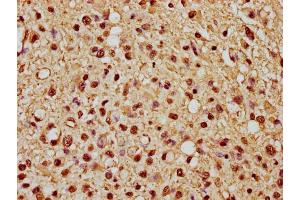 IHC image of nme1HU diluted at 1:10 and staining in paraffin-embedded human glioma cancer performed on a Leica BondTM system.