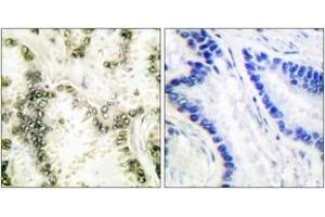Immunohistochemistry analysis of paraffin-embedded human lung carcinoma tissue, using Ku70 Antibody. (XRCC6 Antikörper  (AA 560-609))