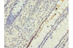 Immunohistochemistry of paraffin-embedded human colon cancer using ABIN7174232 at dilution of 1:100 (UBQLNL Antikörper  (AA 305-475))
