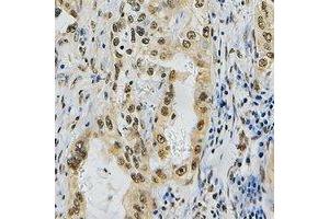 Immunohistochemical analysis of ZNF436 staining in human lung cancer formalin fixed paraffin embedded tissue section. (ZNF436 Antikörper)