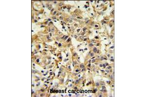 CA6 Antibody IHC analysis in formalin fixed and paraffin embedded breast carcinoma followed by peroxidase conjugation of the secondary antibody and DAB staining. (CA6 Antikörper  (C-Term))