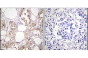 Immunohistochemistry analysis of paraffin-embedded human breast carcinoma, using CDK7 (Phospho-Thr170) Antibody. (CDK7 Antikörper  (pThr170))