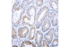 Immunohistochemical analysis of Cytokeratin 18 (pS33) staining in human colon cancer formalin fixed paraffin embedded tissue section. (Cytokeratin 18 Antikörper  (N-Term, pSer33))