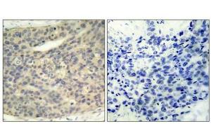 Immunohistochemical analysis of paraffin-embedded human breast carcinoma tissue using LIMK1(Phospho-Thr508) Antibody(left) or the same antibody preincubated with blocking peptide(right). (LIM Domain Kinase 1 Antikörper  (pThr508))