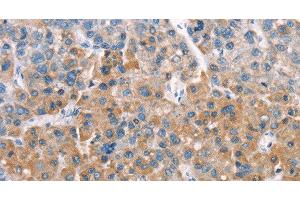 Immunohistochemistry of paraffin-embedded Human liver cancer tissue using LATS2 Polyclonal Antibody at dilution 1:30 (LATS2 Antikörper)