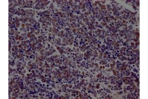 IHC image of ABIN7127456 diluted at 1:100 and staining in paraffin-embedded human lung cancer performed on a Leica BondTM system. (Rekombinanter LIG1 Antikörper)