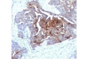 IHC testing of human ovarian carcinoma with TAG-72 antibody. (TAG-72 Antikörper)