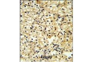 TR Antibody (C-term) 6545b IHC analysis in formalin fixed and paraffin embedded kidney carcinoma followed by peroxidase conjugation of the secondary antibody and DAB staining. (CD40 Ligand Antikörper  (C-Term))