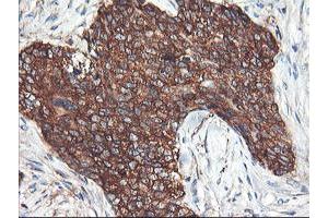 Immunohistochemical staining of paraffin-embedded Adenocarcinoma of Human breast tissue using anti-PFKP mouse monoclonal antibody. (PFKP Antikörper)