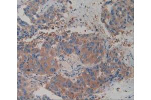 IHC-P analysis of Human Breast Cancer Tissue, with DAB staining. (alpha Actinin 4 Antikörper  (AA 1-269))