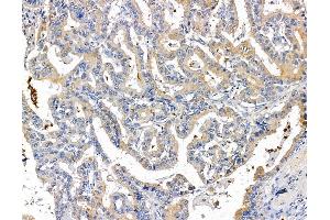 ABIN7095207 and ABIN7099263 at 1/100 staining human liver cancer by IHC-P. (GPBAR1 Antikörper)