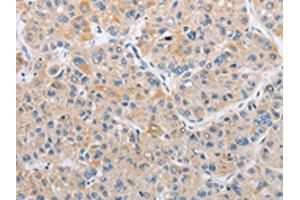 The image on the left is immunohistochemistry of paraffin-embedded Human liver cancer tissue using ABIN7128506(ARHGEF9 Antibody) at dilution 1/50, on the right is treated with fusion protein. (Arhgef9 Antikörper)