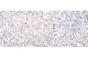 Immunohistochemistry of paraffin-embedded Human cervical cancer tissue using SLC25A27 Polyclonal Antibody at dilution of 1:30(x200) (SLC25A27 Antikörper)