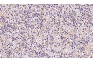 ABIN6273083 at 1/100 staining Human lymph cancer tissue by IHC-P. (TOMM40 Antikörper  (Internal Region))