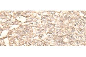 Immunohistochemistry of paraffin-embedded Human lung cancer tissue using RAD23B Polyclonal Antibody at dilution of 1:25(x200) (RAD23B Antikörper)