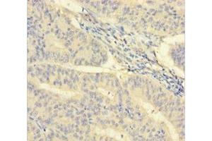 Immunohistochemistry of paraffin-embedded human endometrial cancer using ABIN7156965 at dilution of 1:100 (ISX Antikörper  (AA 1-245))