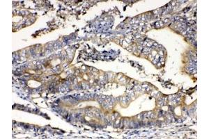 IHC testing of FFPE human intestinal cancer tissue with Calpain 2 antibody at 1ug/ml. (Calpain 2 Antikörper)