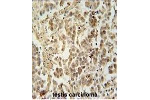 LUZP4 Antibody (N-term) (ABIN654223 and ABIN2844059) immunohistochemistry analysis in formalin fixed and paraffin embedded human testis carcinoma followed by peroxidase conjugation of the secondary antibody and DAB staining.