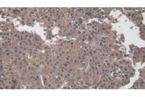 Detection of COL1a2 in Human Liver cancer Tissue using Polyclonal Antibody to Collagen Type I Alpha 2 (COL1a2) (COL1A2 Antikörper  (AA 1103-1366))