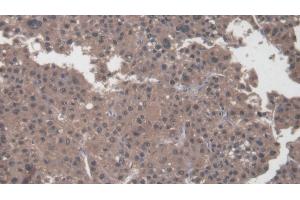 Detection of COL1a2 in Human Liver cancer Tissue using Polyclonal Antibody to Collagen Type I Alpha 2 (COL1a2)