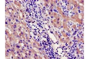 Immunohistochemistry of paraffin-embedded human liver cancer using ABIN7142182 at dilution of 1:100 (CYP39A1 Antikörper  (AA 235-392))