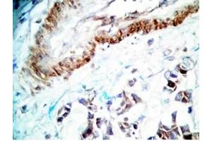 Human stomach cancer tissue was stained by rabbit Anti-Spexin prepro (36-58)  (H) Antiserum (Spexin Antikörper  (Preproprotein))