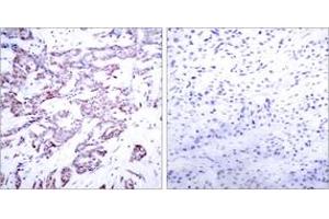 Immunohistochemistry analysis of paraffin-embedded human breast carcinoma, using STAT6 (Phospho-Thr645) Antibody. (STAT6 Antikörper  (pThr645))
