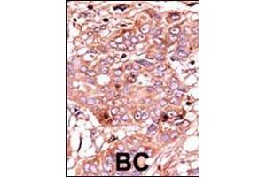 Formalin-fixed and paraffin-embedded human cancer tissue reacted with the primary antibody, which was peroxidase-conjugated to the secondary antibody, followed by AEC staining. (ABL1 Antikörper  (pTyr251))