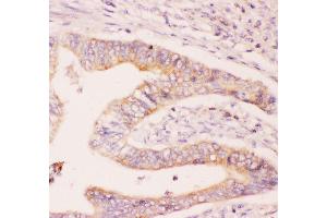 Anti-MCL1 Picoband antibody,  IHC(P): Human Intestinal Cancer Tissue (MCL-1 Antikörper  (AA 1-350))