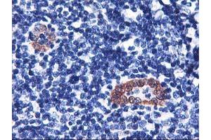 Immunohistochemical staining of paraffin-embedded Human lymphoma tissue using anti-LMCD1 mouse monoclonal antibody. (LMCD1 Antikörper)