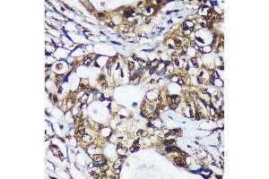 Immunohistochemistry of paraffin-embedded Human colon carcinoma using TSN Rabbit pAb  at dilution of 1:100 (40x lens). (Translin Antikörper  (AA 50-150))